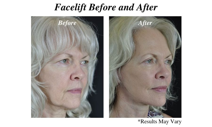Before and after image showing the results of a facelift surgery performed in Scottsdale, AZ.