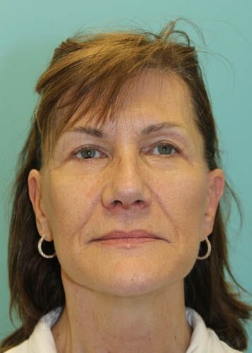 Before And After Face Lift Patient 03 Gallery Robert J Spies Md Facs
