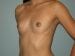 Breast Augmentation Patient 35 - Before Thumbnail 