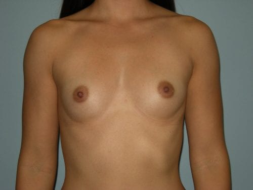 Breast Augmentation Patient 35 - Before 