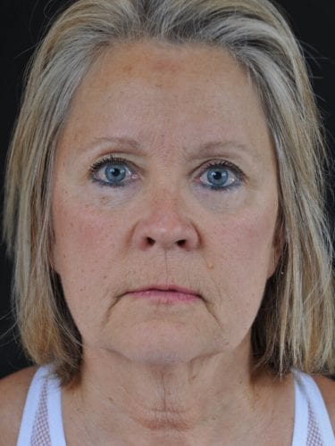 Before And After Face Lift Patient 20 Gallery Robert J Spies Md Facs