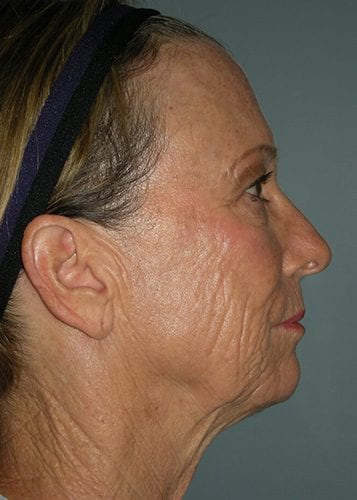 Before And After Face Lift Patient 22 Gallery Robert J Spies Md Facs