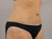 Tummy Tuck Patient 26 - After Thumbnail 