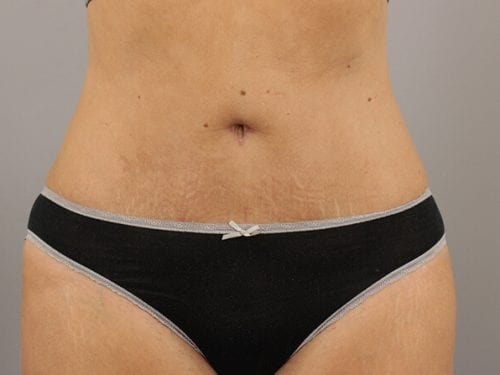 Tummy Tuck Patient 26 - After 