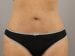 Tummy Tuck Patient 26 - After Thumbnail 