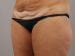 Tummy Tuck Patient 26 - Before Thumbnail 
