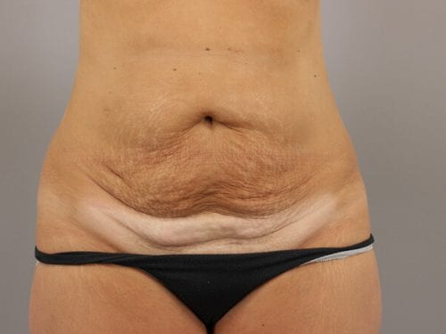 Tummy Tuck Patient 26 - Before 